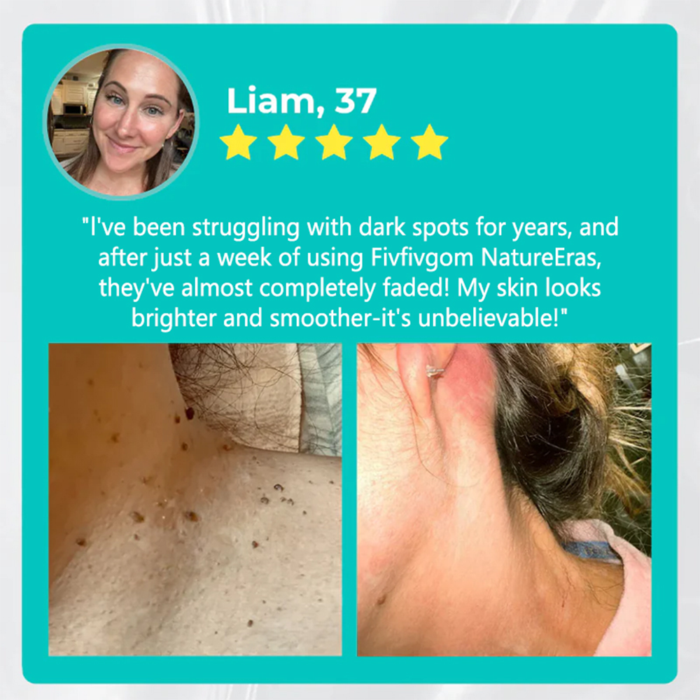 ✅ Official Store: LOVILDS™ NatureErase Instant Alligator Oil Mole & Spot Removal Plus Gel