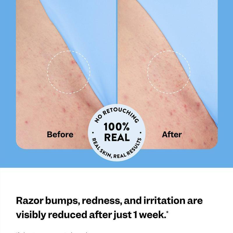 🔥 🔥🔥Only 3 Hours Left! 60% OFF Smoothing Solution Ingrown Hair Treatment: Glide Your Way to Silky-Smooth, Bump-Free Skin